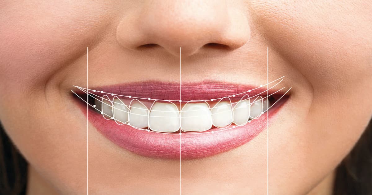 Finding the Perfect Invisalign Dentist in Vaughan & Toronto