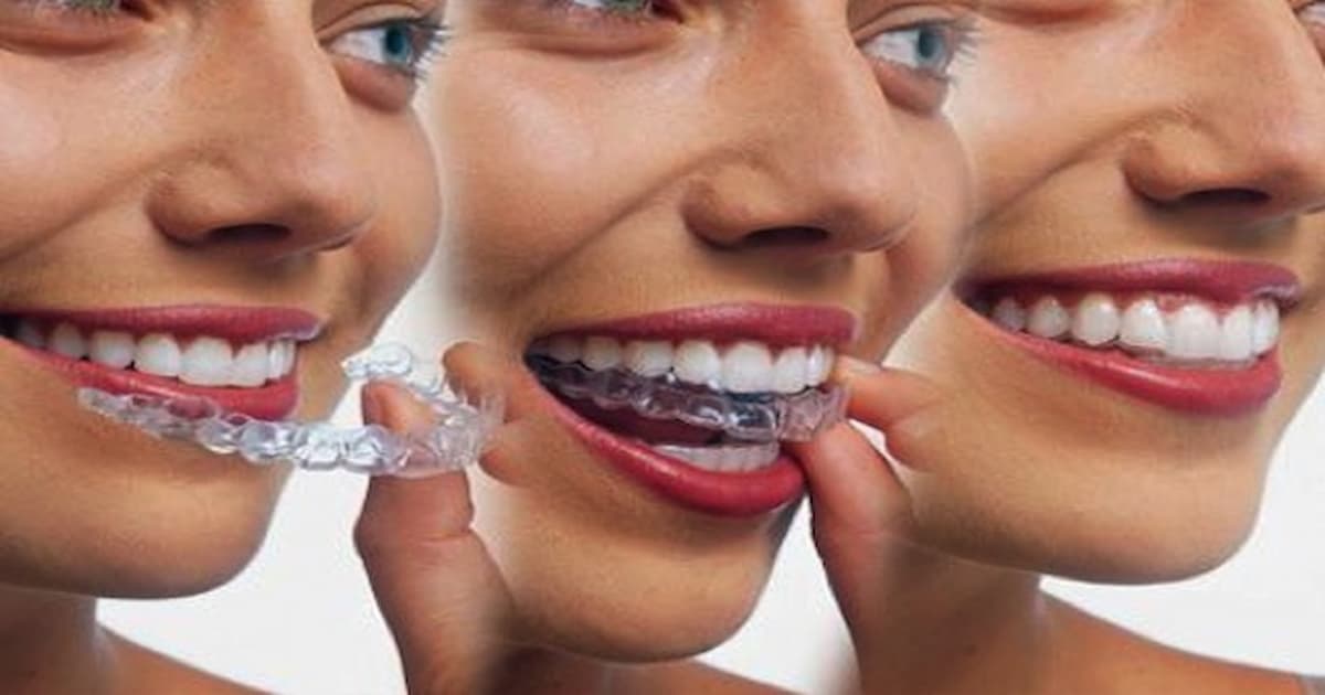 The Cost of Invisalign Treatment